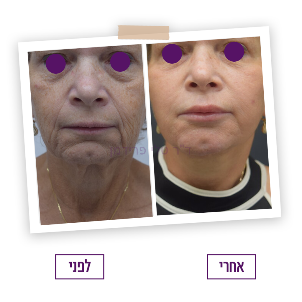 תמונות מתיחת פנים לפני ואחרי